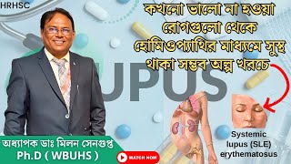 Treatment of systemic lupus erythematosus হোমিওপ্যাথিক সাফল্য । Follow Up Case by DrMilan Senupta [upl. by Aihsram]