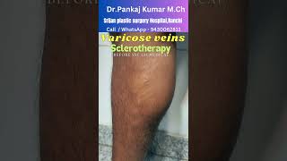 15824 Foam Sclerotherapy treatment for varicose veins Varicose veins treatment before SSC GD [upl. by Ahsiekar]