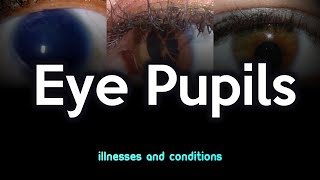 Eye Pupils Illnesses and Conditions [upl. by Leirbag81]