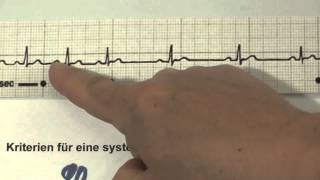 EKG für Pflege Teil 13  atemabhängige Sinusarrhythmie interpretieren [upl. by Ruhnke50]