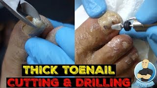 HOW TO FIX A THICK DAMAGED TOENAIL IN 5 MINUTES [upl. by Aicirt113]