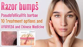 Razor bumps treatment  10 Treatment options of pseudofolliculitis barbae  Ayurveda medicine [upl. by Dralliw601]