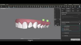 How to make your Invisalign clinchecks simpler more predictable and minimize anterior attachments [upl. by Kcirddec]