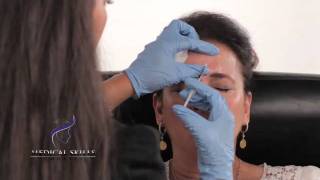 Botulinum Toxin  Injection Technique [upl. by Pierce]