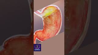 Gastric Reflux  3D animation [upl. by Gaelan]