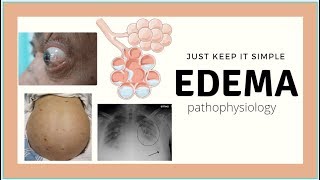 Edema Pathophysiology  Pulmonary edema Ascites physiology basics Med Madness [upl. by Coheman]