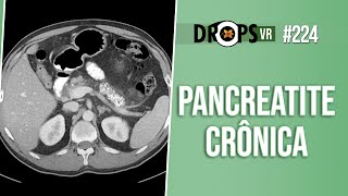 PANCREATITE CRÔNICA ACHADOS DE IMAGEM E CLÍNICA [upl. by Anthia]