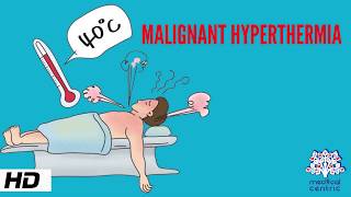 MALIGNANT HYPERTHERMIA Causes Signs and Symptoms Diagnosis and Treatment [upl. by Alyk]