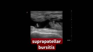 Suprapatellar bursitis MSK Ultrasound [upl. by Bully]