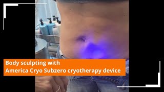 Bodysculpting reduces stubborn belly fat using America Cryos Subzero localized cryotherapy [upl. by Doykos]