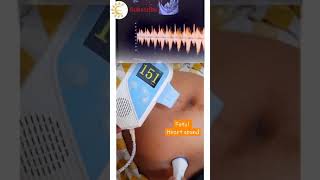 Fetal Heart sound  Nonstress Test Pregnancy nst fetal heart sound shortsvideo [upl. by Yemane]