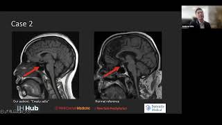 IIH MRI Findings in a Patient with Blurry Vision Headaches Tinnitus and Papilledema on Fundoscopy [upl. by Anthia]