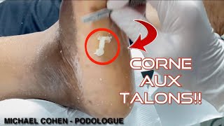 CORNE AUX TALONS 3  Michaël Cohen Pédicure Podologue à Créteil 94 [upl. by Madigan544]