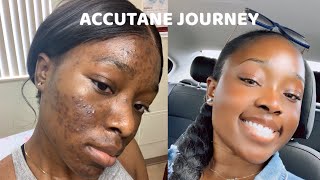 FINAL ISOTRETINOIN ACCUTANE UPDATE  HOW I GOT RID OF HYPERPIGMENTATION  ELLIANE KHESHEN [upl. by Thornburg437]