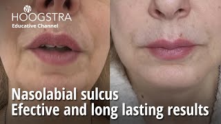 Nasolabial sulcus  Efective and long lasting results  24118 [upl. by Korman]