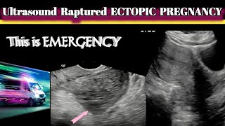 Ultrasound Raptured Ectopic Pregnancy  Emergency Scan [upl. by Bertha265]