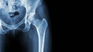 left hip Xray soft tissues iliofemoral ligament gluteal muscles puborectalis [upl. by Nwadal]