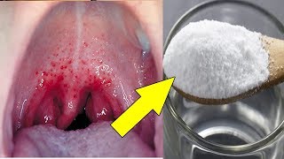 How To Get Rid of Sore Throat fast 9 Natural Remedies for Sore Throat [upl. by Dallon]