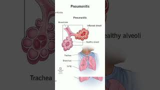 Pneumonitis shorts [upl. by Wolbrom]