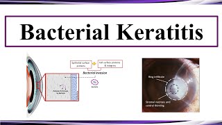 Bacterial Keratitis [upl. by Bertha]