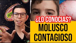 MOLUSCO QUE Todo sobre MOLUSCO CONTAGIOSO  DrPoloGuerrero [upl. by Regina]