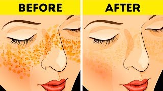 How to Get Rid of Acne Scars In Just 3 Days [upl. by Ahseret]