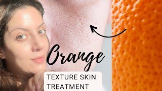 Treatment for textured skin I Oily Skincare I Treatment for large open pores and textured skin [upl. by Moshe91]