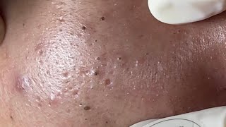 BLACKHEAD P2  Acne Treatment Mai Ngoc Da Nang [upl. by Phelps472]