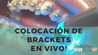 Colocación de Brackets en VIVO  Putting on Braces  LIVE [upl. by Demodena767]