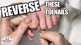 Pedicure at Home Toenail Cleaning nails satisfying [upl. by Sams]