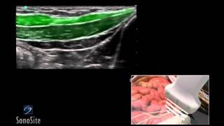 How To Ilioinguinal and Iliohypogastric Regional Nerve Block 3D Video [upl. by Ajnotal]