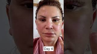 Facelift Patients 3 Week Healing amp Recovery Process [upl. by Acinnor]