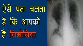 निमोनिया क्या है और जाने इसके लक्षण  Pneumonia symptoms [upl. by Durwyn]