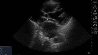 Massive Aneurysm of Descending Thoracic Aorta [upl. by Neysa]