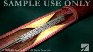 Stent Angioplasty  ANC00202 [upl. by Wong]