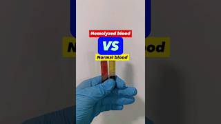 Hemolyzed blood vs Normal blood serum sample medtech medtechstudent laboratory bloodserum blood [upl. by Blinnie]