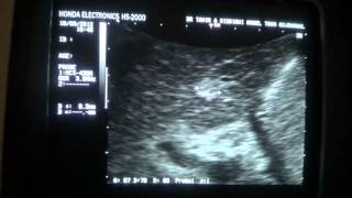 differentiating liver hemangioma vs lig teres sonographically [upl. by Bathesda]