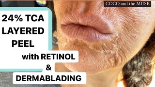 AT HOME BEST PEEL EVER 24 TCA RETINOL amp DERMAPLANE  VI Peel DUPE  Complete Procedure [upl. by Evadnee]