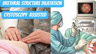 URETHRAL STRICTURE DILATATION USING CYSTOSCOPY [upl. by December]