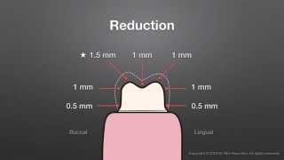 Full Metal Crown Preparation Requirements Keynote slide lower right 1st molar [upl. by Lavoie]