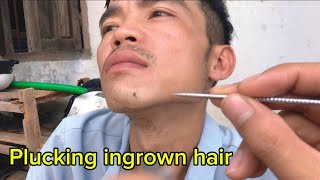 I think Plucking ingrown hair but sure hairy mole formr Luc ASMR [upl. by Bubalo]