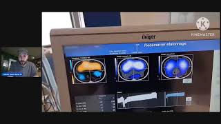 PulmoVista 500 Guided Recruitment of Dorsal Atelectasis Using APRV  Prone Position [upl. by Gasper]