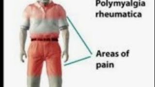 Polymyalgia rheumatica lecture [upl. by Bunch422]