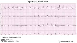 Right Bundle Branch Block RBBB pattern [upl. by Aisek]