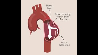 Aortic Dissection [upl. by Sitelc]