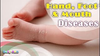 Hand Foot and Mouth Disease  Treatment of Hand Foot amp Mouth Disease Treatment and When to Worry [upl. by Pierrette759]