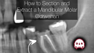 How to Section and Extract a Mandibular Molar drwahan [upl. by Yerffoj]