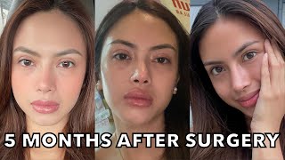 Upper Blepharoplasty amp Rhinoplasty Update 5 months after [upl. by Warfield]