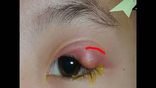 STYE  Disease of an Eyelid [upl. by Tarrel]