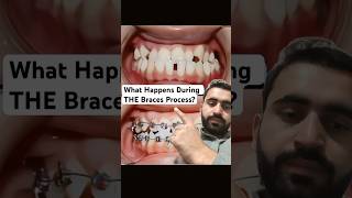 What Happens During THE Braces Processbraces dentist orthodontist dentistry bracesadjustment [upl. by Jennie]